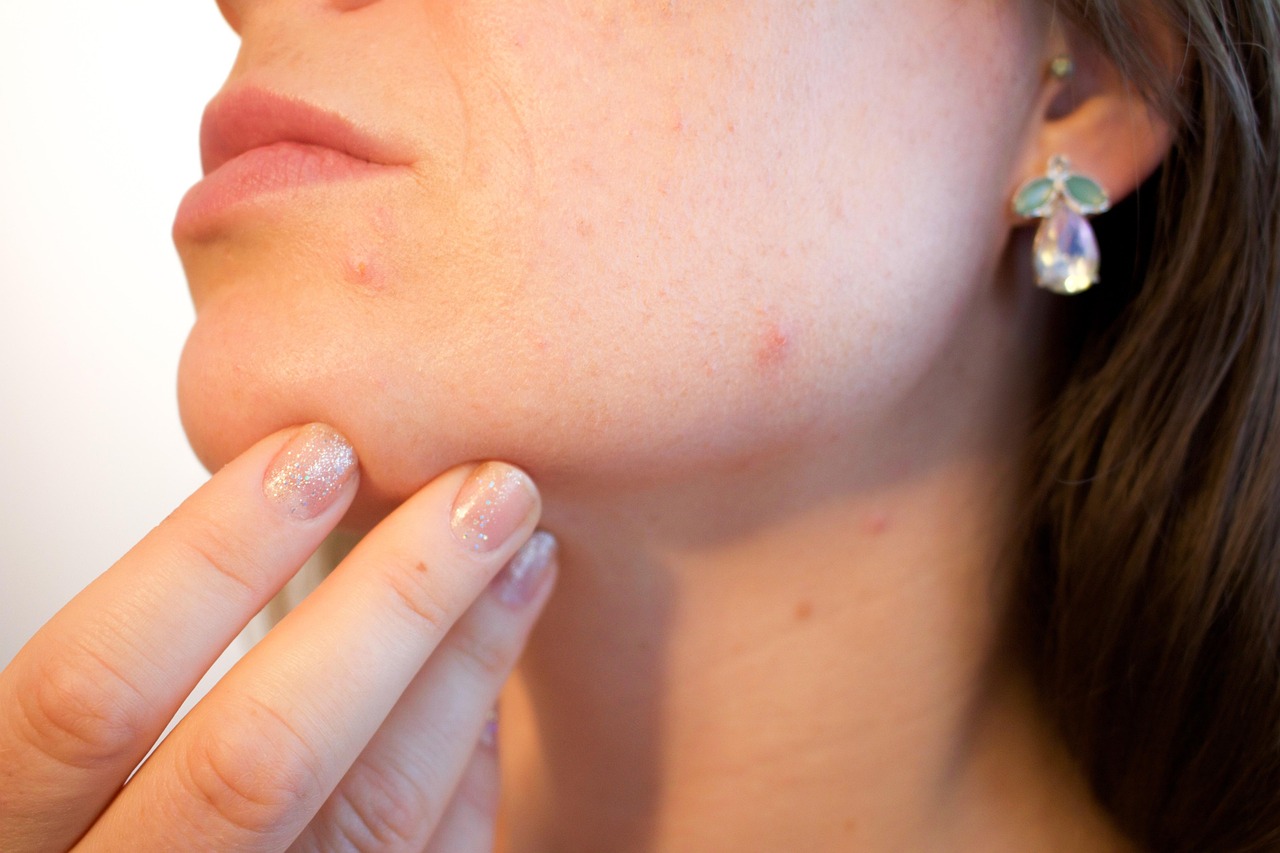 Acne and clogged pores on the skin